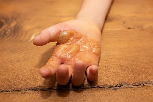 cách sơ cứu bỏng