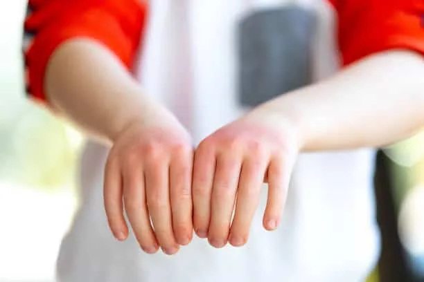 sơ cứu khi bị bỏng nước sôi