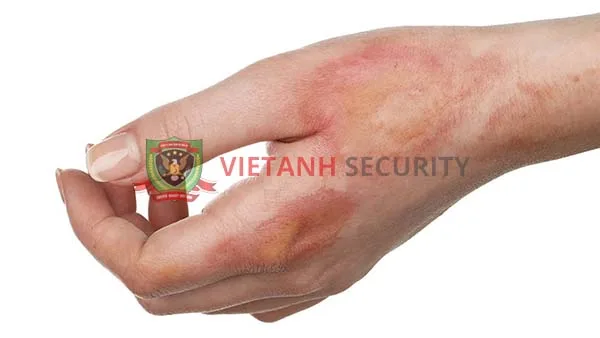 Bỏng do nhiệt là loại bỏng thường gặp