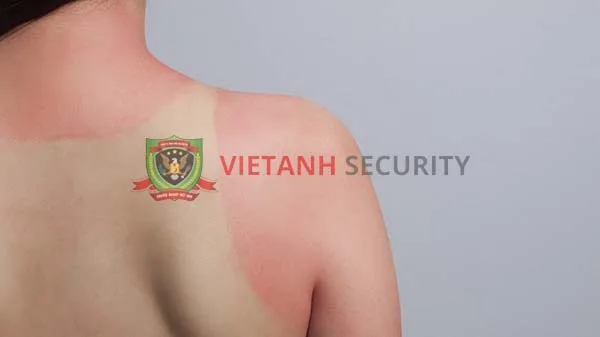 Bỏng do cháy nắng 