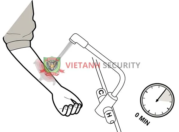 Cho bộ phận bị bỏng nhiệt dưới nước mát từ 10 -15 phút