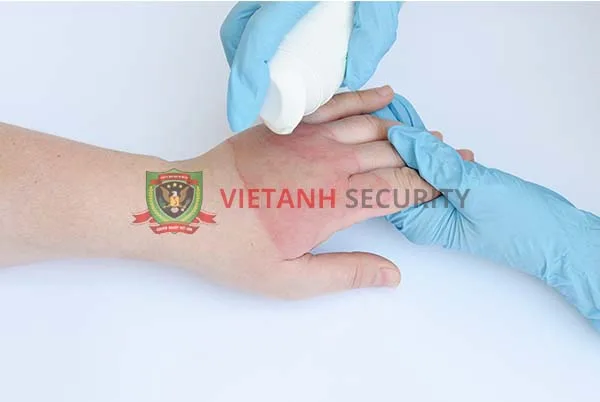 Cách chữa bỏng