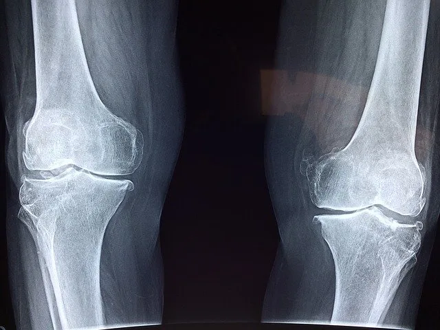 Hình chụp X-ray xương đầu gối x ray gãy xương