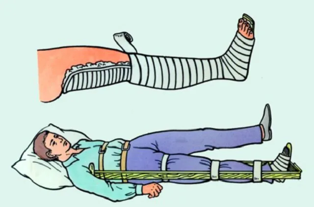 Sơ cứu cố định xương chân sơ cứu gãy xương chân