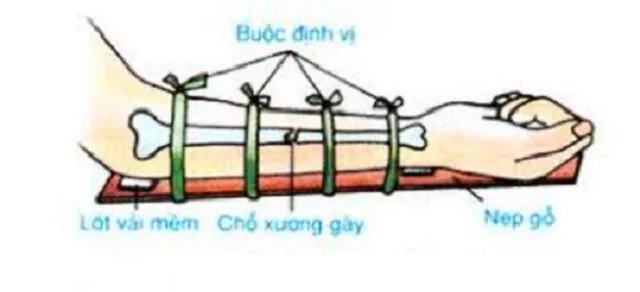 Sơ cứu gãy xương cẳng tay sơ cứu gãy xương tay