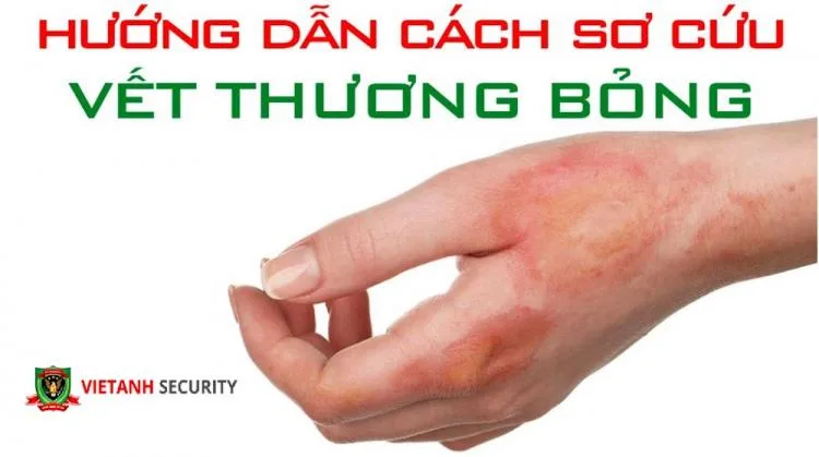 sơ cứu bỏng