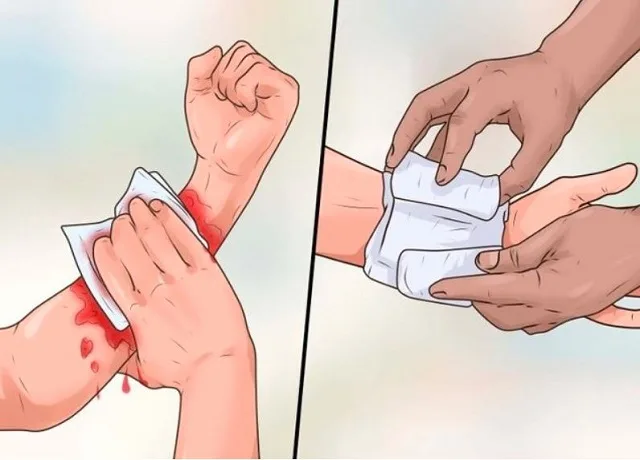 sơ cứu vết thương chảy máu ngoài