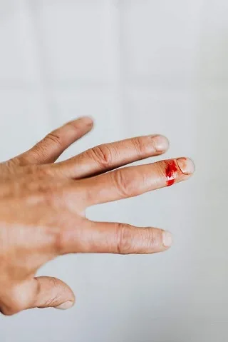 vết thương chảy máu ngoài
